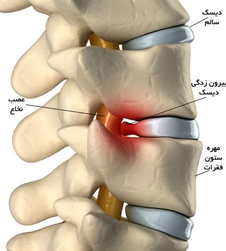 دیسک کمر چیست؟