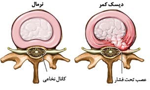 علت ايجاد فتق ديسک کمر چيست؟