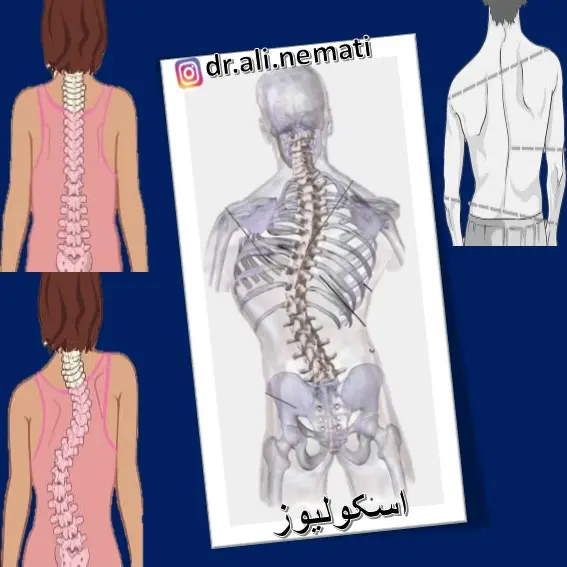 اسکولیوز : خم شدن ستون فقرات ازیک طرف