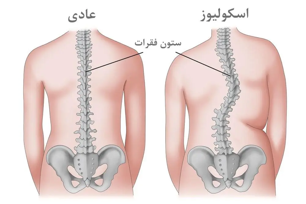 اسکولیوز مادرزادی