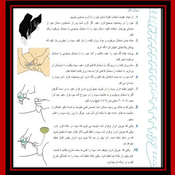 روش کار با سونداژ یا کاتتر دستی