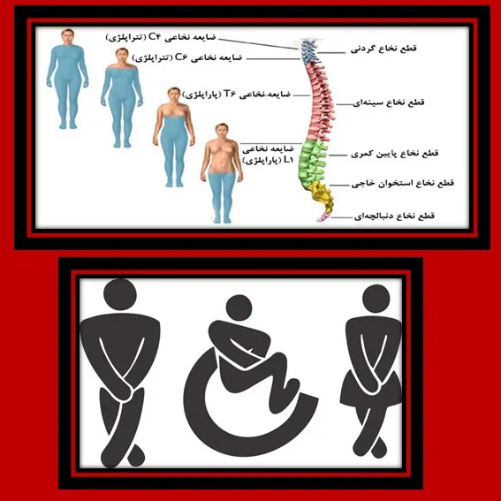پس از آسیب نخاعی و اثرات بی اختیاری ادرار