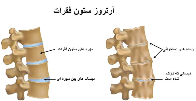 آرتروز ستون فقرات