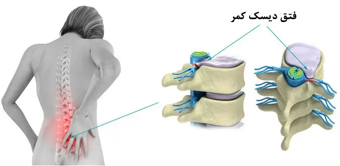 مدیریت فتق دیسک کمر
