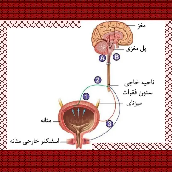 درمان بی اختیاری ادرار در اثر ضایعه نخاعی