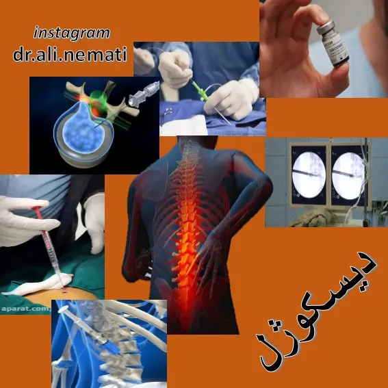 دیسکوژل (روش بدون جراحی)