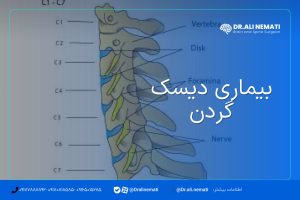بیماری دیسک گردن