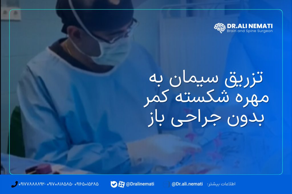 تزریق سیمان به مهره شکسته کمر بدون جراحی باز