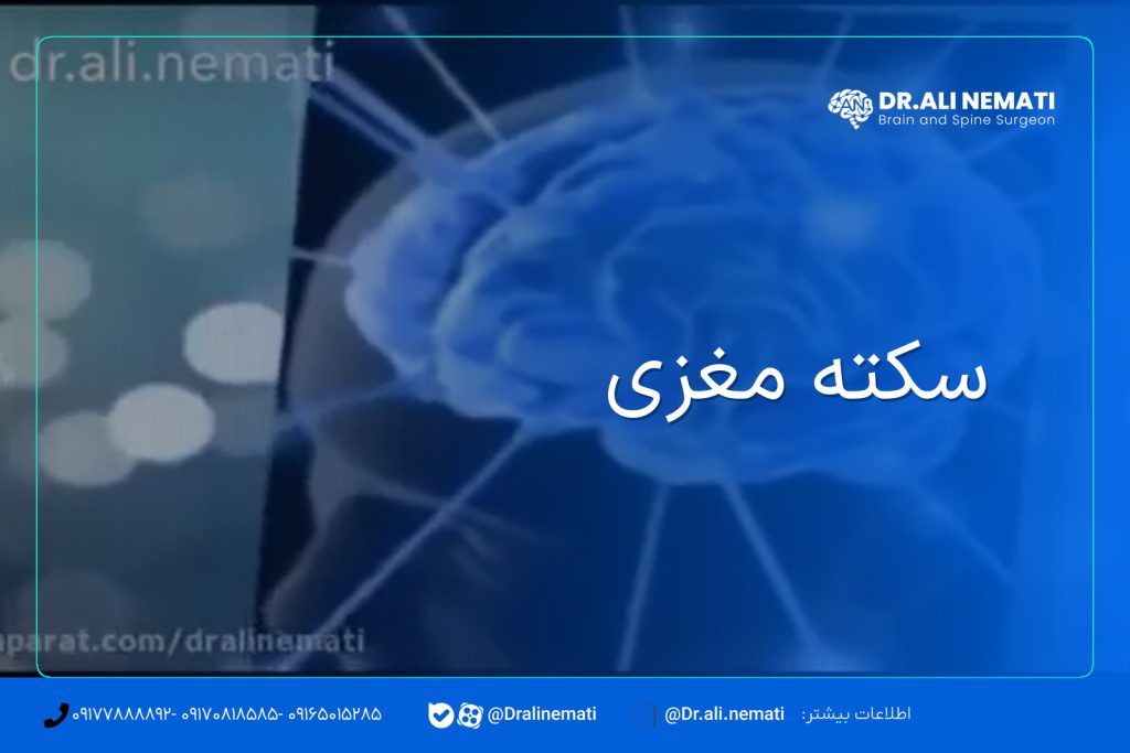 سکته مغزی
