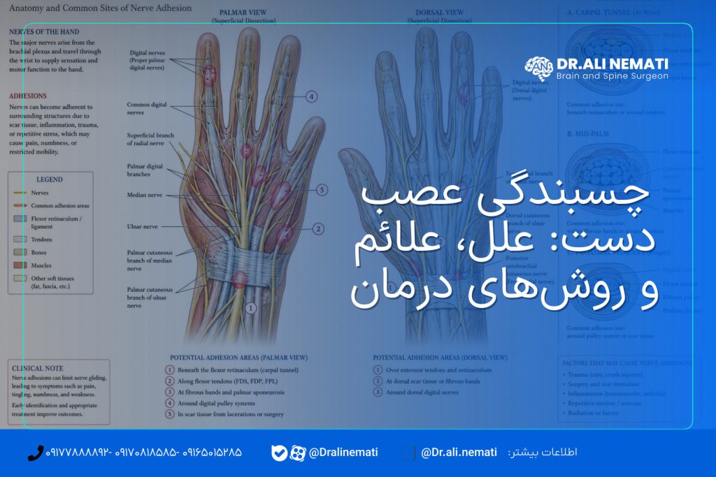 چسبندگی عصب دست: علل، علائم و روش‌های درمان