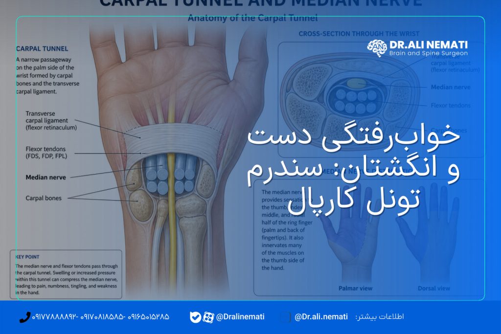 خواب‌رفتگی دست و انگشتان: سندرم تونل کارپال