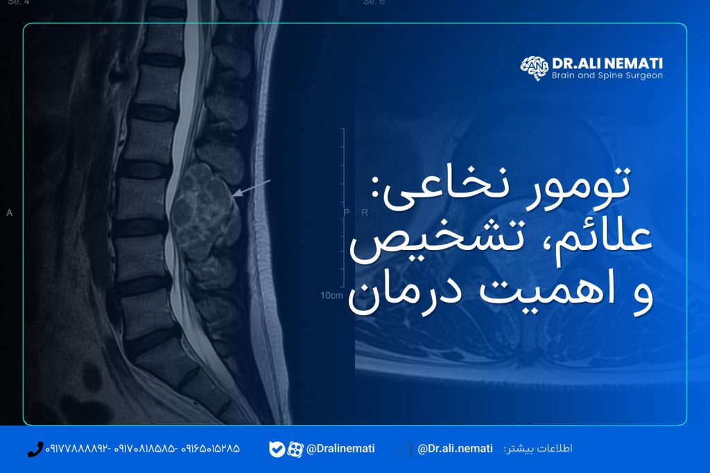 تومور نخاعی: علائم، تشخیص و اهمیت درمان