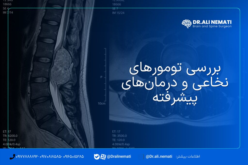 بررسی تومورهای نخاعی و درمان‌های پیشرفته